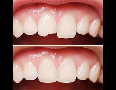 before and after of dental bonding