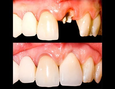 before and after of dental crown