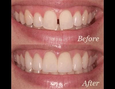 before and after of invisalign® treatment