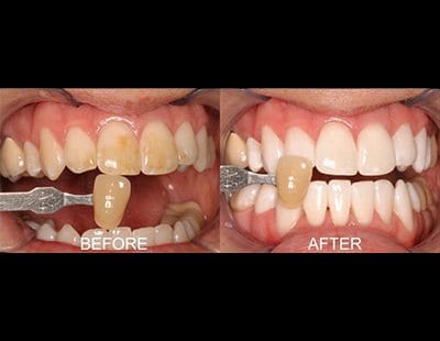 before and after of teeth-whitening