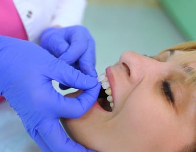 A dentist applying veneers to a female patient’s smile