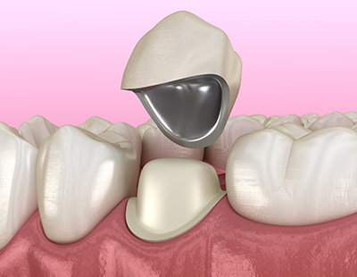 3D render of a dental crown