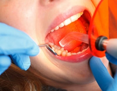 dentist curing composite resin