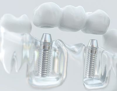 model of an implant-retained bridge being placed