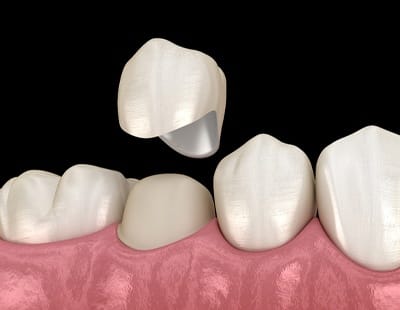 How a dental crown works