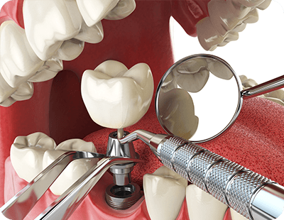 dental instruments placing a dental implant in Frederick 