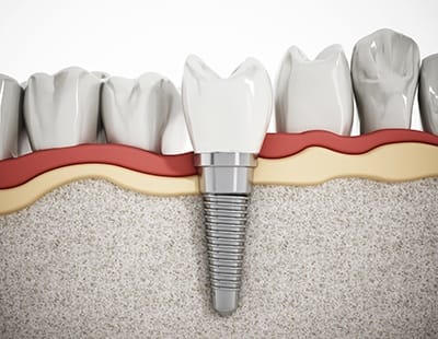 single dental implant post in the jawbone 