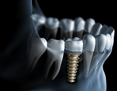 single dental implant and crown on bottom arch 