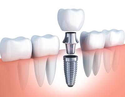dental implant, abutment, and crown 