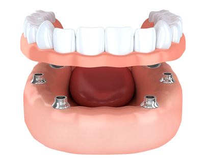 implant-retained dentures