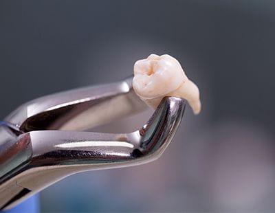 Metal clasp holding extracted tooth