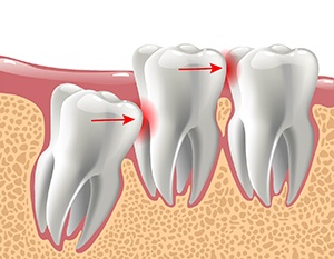 Diagram of an impacted tooth in need of extraction in Frederick