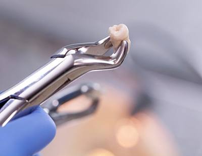 dentist in Frederick holding an extracted tooth in a dental instrument 