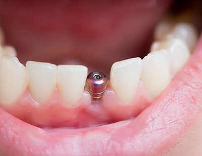 Close-up of dental implant in Frederick, MD in healthy mouth