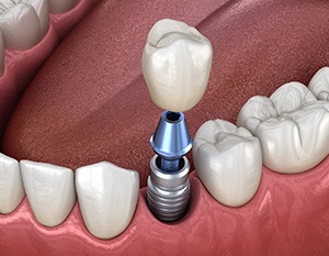 Diagram showing components of a dental implant in Frederick