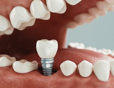 A digital image of a single tooth dental implant sitting in the lower arch between two healthy teeth