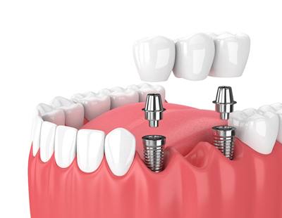 An implant bridge with abutments