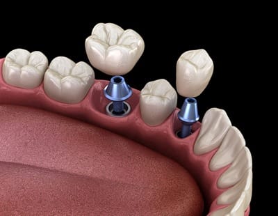 Dental implant crown restorations
