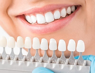 Smile compared with tooth color chart