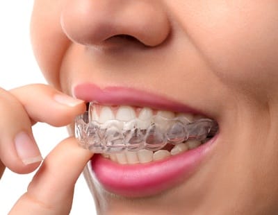 Woman putting in a clear aligner tray