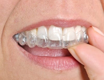 A person inserting an Invisalign aligner