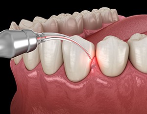 Illustration of soft tissue laser being used on gums
