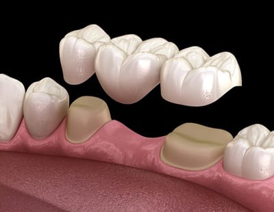 A diagram of a traditional dental bridge.