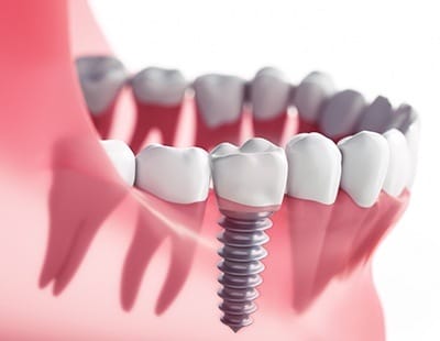 Aniamtion of implant supported dental crown
