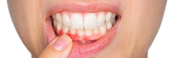 Closeup of inflamed gums
