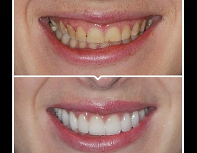 before and after of porcelain veneers