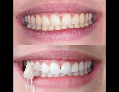 before and after of teeth-whitening