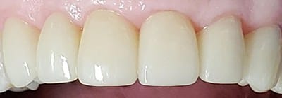 Flawlessly restored front teeth