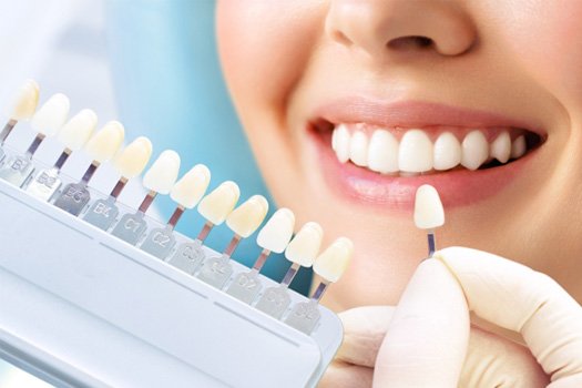 Nose-to-chin view of woman’s smile with shade guide held to teeth