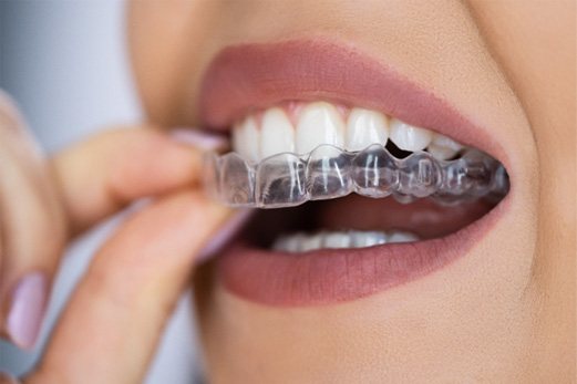Woman removing clear aligners from upper arch