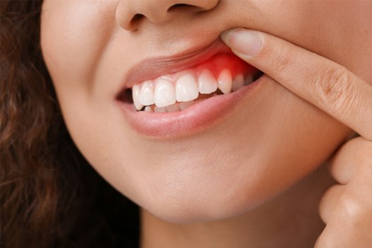 Nose-to-chin view of woman pulling back lip with single finger to reveal red gums