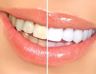 A young man wearing a blue shirt points to his smile after completing teeth whitening treatment