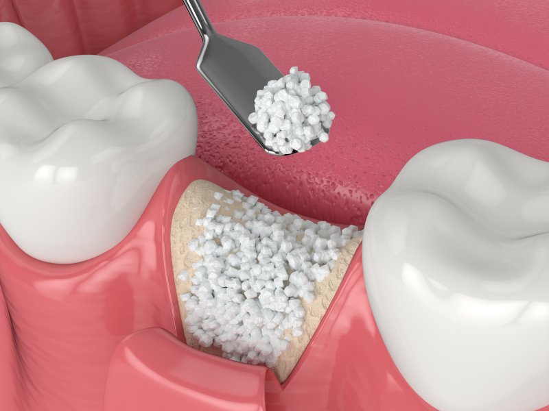 3-D image of a bone graft