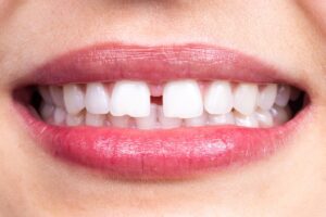 Close-up of smile with gap between front teeth.